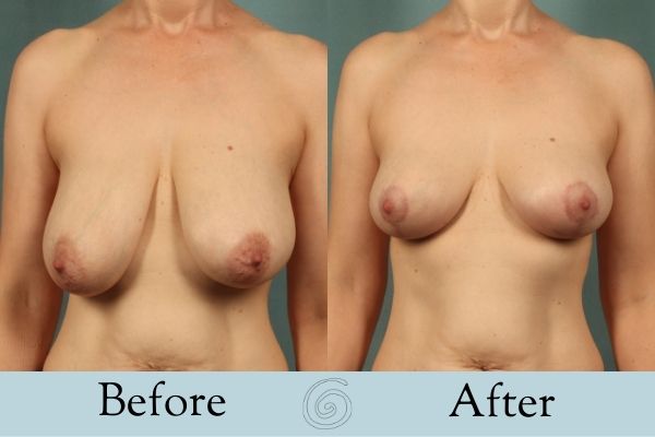 Breast Lift Before and After 1 _ Front