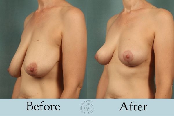 Breast Lift Before and After 1 _ Side