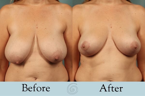 Breast Lift Before and After 2 _ Front