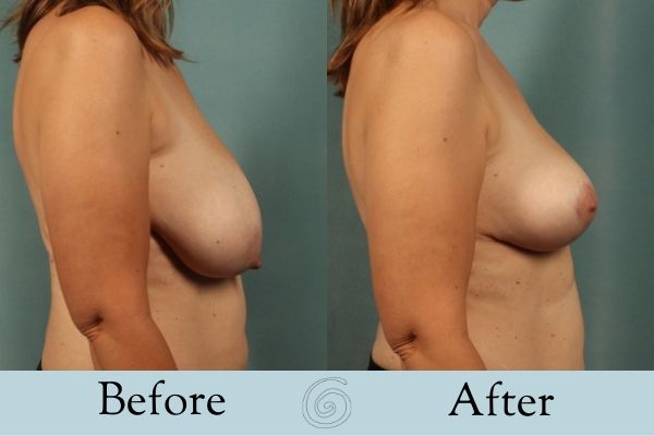 Breast Lift Before and After 2 _ Side