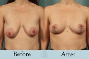 Breast Lift Before and After 3 _ Front