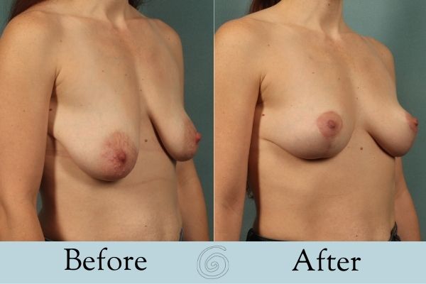 Breast Lift Before and After 3 _ Side