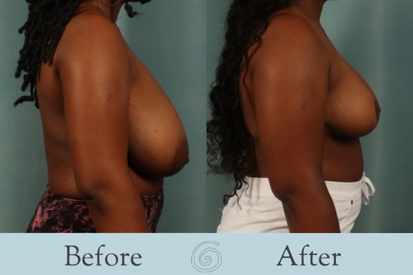 Breast Reduction Before and After 1 - Side