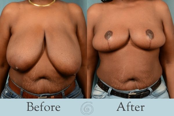 Breast Reduction Before and After 10 - Front