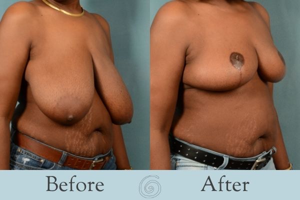 Breast Reduction Before and After 10 - Side