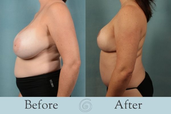 Breast Reduction Before and After 12 - Side