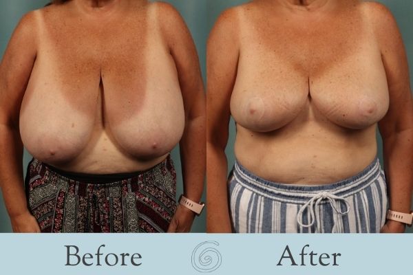 Breast Reduction Before and After 2 - Front