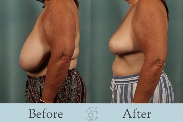 Breast Reduction Before and After 2 - Side