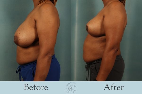 Breast Reduction Before and After 3 - Side