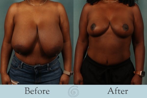Breast Reduction Before and After 4 - Front