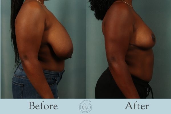 Breast Reduction Before and After 4 - Side