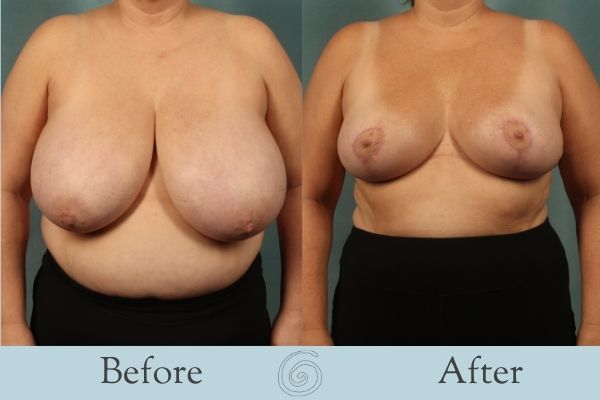 Breast Reduction Before and After 5 - Front