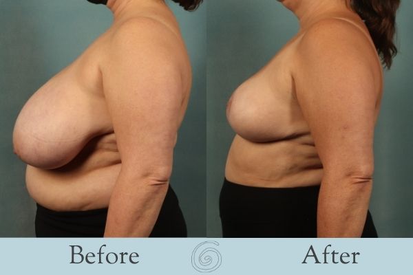 Breast Reduction Before and After 5 - Side