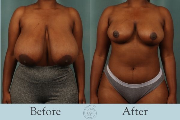 Breast Reduction Before and After 6 - Front