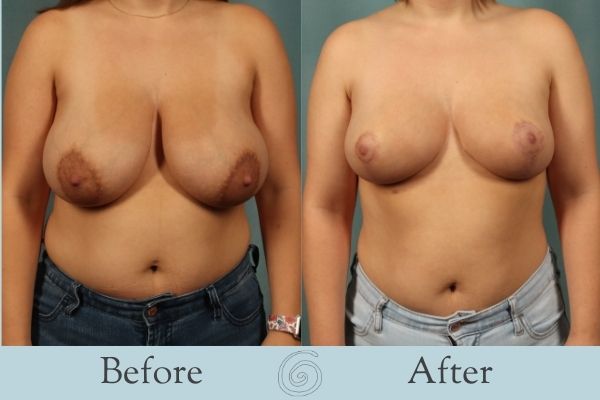 Breast Reduction Before and After 7 - Front