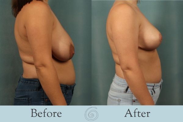 Breast Reduction Before and After 7 - Side