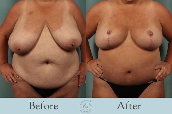 Breast Reduction Before and After 8 - Front