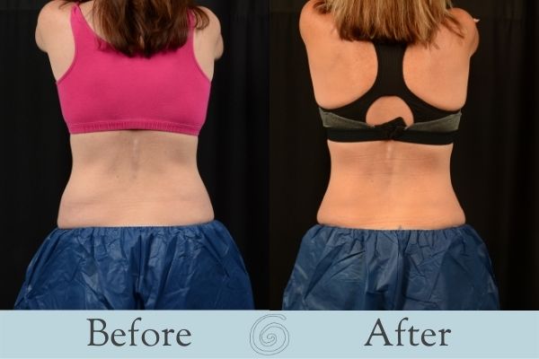 CoolSculpting Before and After 2 - Back