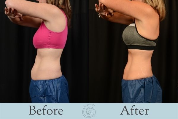 CoolSculpting Before and After 2 - Side