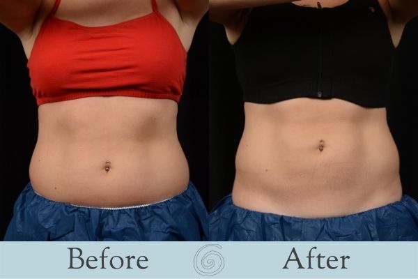 CoolSculpting Before and After 3 - Front