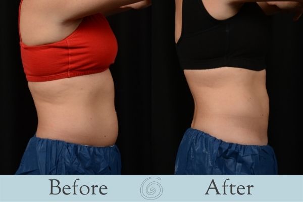 CoolSculpting Before and After 3 - Side