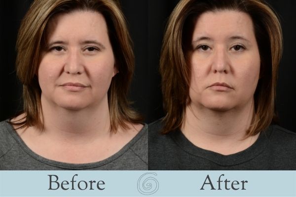 CoolSculpting Before and After 4 - Front