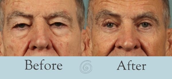 Eyelid Surgery Before and After 1 - Front