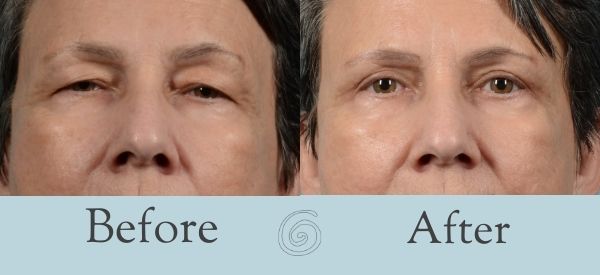 Eyelid Surgery Before and After 10 - Front