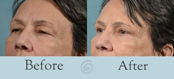 Eyelid Surgery Before and After 10 - Side