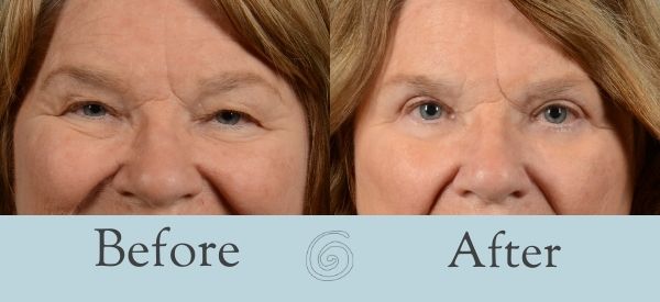 Eyelid Surgery Before and After 11 - Front