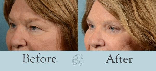 Eyelid Surgery Before and After 11 - Side