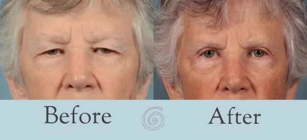 Eyelid Surgery Before and After 12 - Front