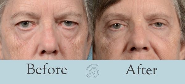 Eyelid Surgery Before and After 14 - Front