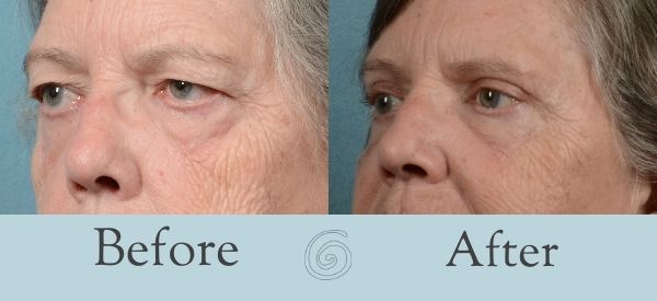 Eyelid Surgery Before and After 14 - Side
