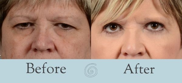 Eyelid Surgery Before and After 15 - Front