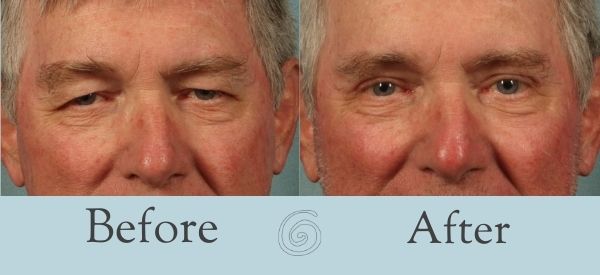 Eyelid Surgery Before and After 18 - Front