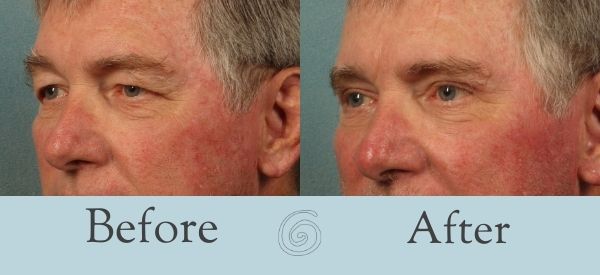 Eyelid Surgery Before and After 18 - Side