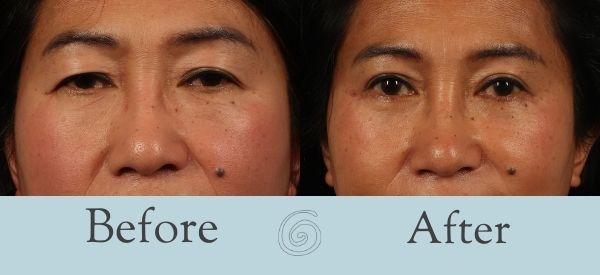 Eyelid Surgery Before and After 19 - Front