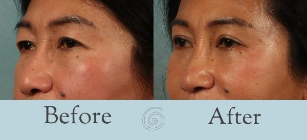 Eyelid Surgery Before and After 19 - Side