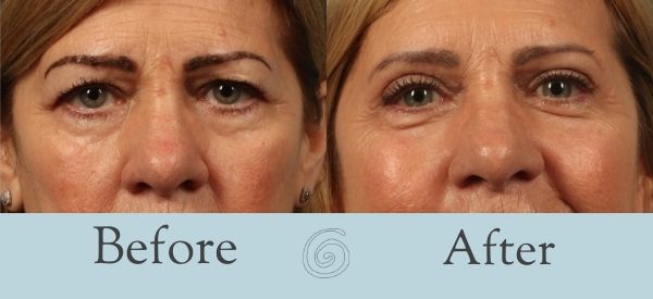 Eyelid Surgery Before and After 2 - Front