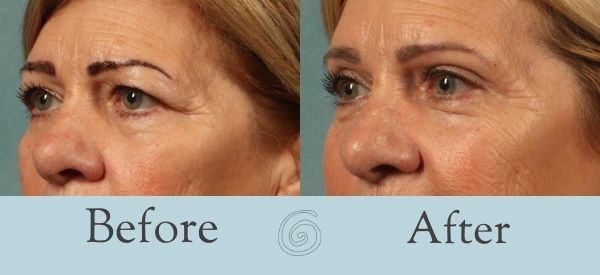 Eyelid Surgery Before and After 2 - Side