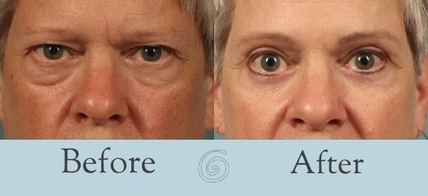 Eyelid Surgery Before and After 20 - Front