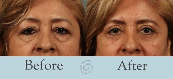 Eyelid Surgery Before and After 3 - Front