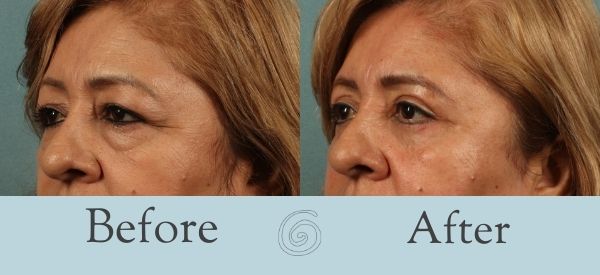 Eyelid Surgery Before and After 3 - Side