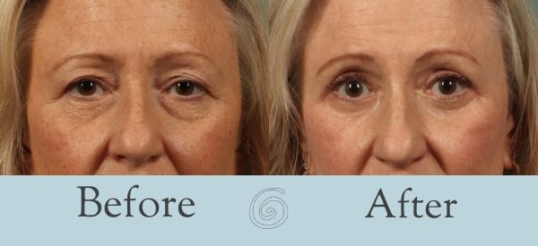 Eyelid Surgery Before and After 4 - Front