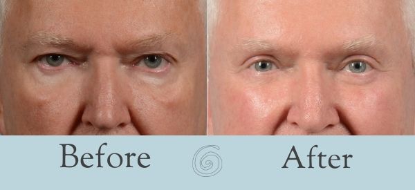 Eyelid Surgery Before and After 5 - Front