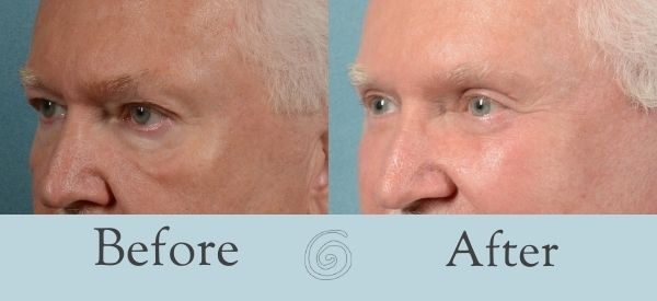 Eyelid Surgery Before and After 5 - Side