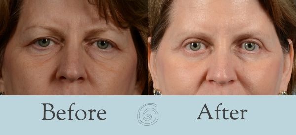 Eyelid Surgery Before and After 6 - Front