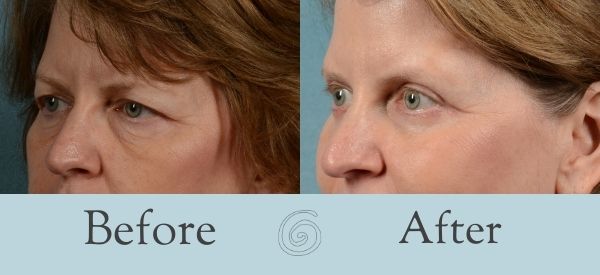Eyelid Surgery Before and After 6 - Side