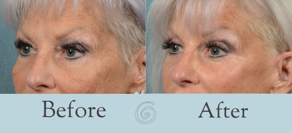 Eyelid Surgery Before and After 7 - Side